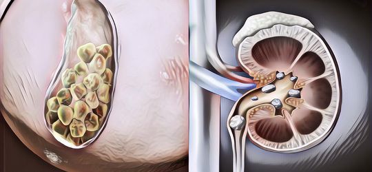 5 Cara Alami Menyembuhkan Batu Empedu, Lebih Hemat dan Tanpa Sakit