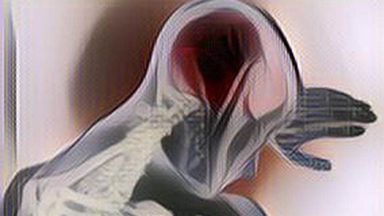 Mengenal Apa itu Aneurisma Otak yang Menyerang Pria Surabaya yang Hampir Tewas Saat Bercinta