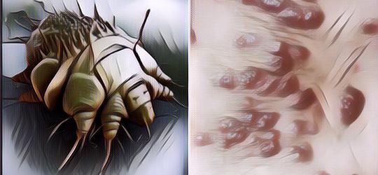 Musim Hujan Datang! Waspada Scabies, Penyakit Kulit dengan Gejala Gatal-Gatal dan Bisa Menular ke Orang Lain