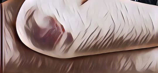 Ada Memar Tanpa Terjatuh, Kenali Pemicunya