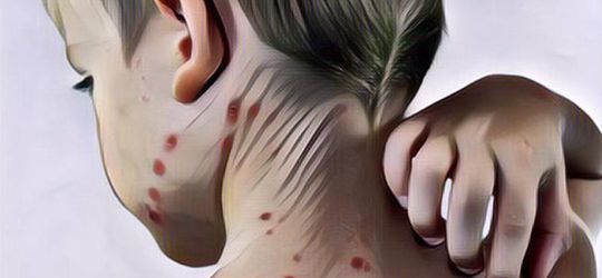 Ternyata, Ini Penyebab Adanya Penyakit Cacar Monyet