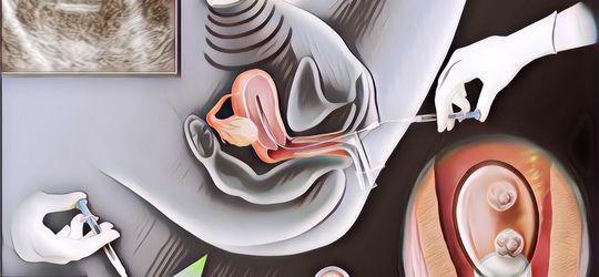 Mengenal Metode Bayi Tabung atau IVF, Bagaimana Cara Kerjanya?