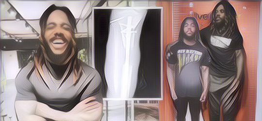 Seorang Pria Nekat Operasi Perpanjang Kaki Karena Sering Diejek Pendek