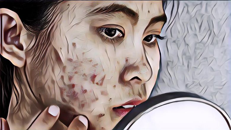 Biar Enggak Salah Penanganan, Yuk Kenali Jenis-jenis Jerawat Wajah