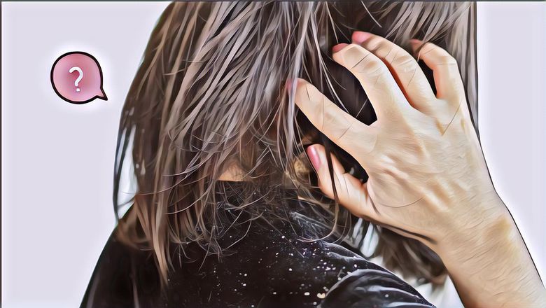 Stress Ketombean Mulu? Yuk, Coba 7 Cara Alami Atasi Ketombe Membandel Berikut Ini Deh!