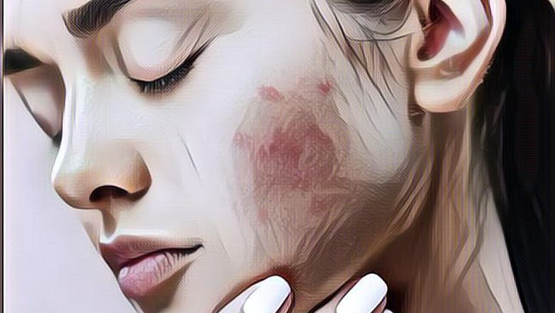 Sering Begadang Bisa Bikin Wajah Jerawatan? Begini Kata Para Ahli