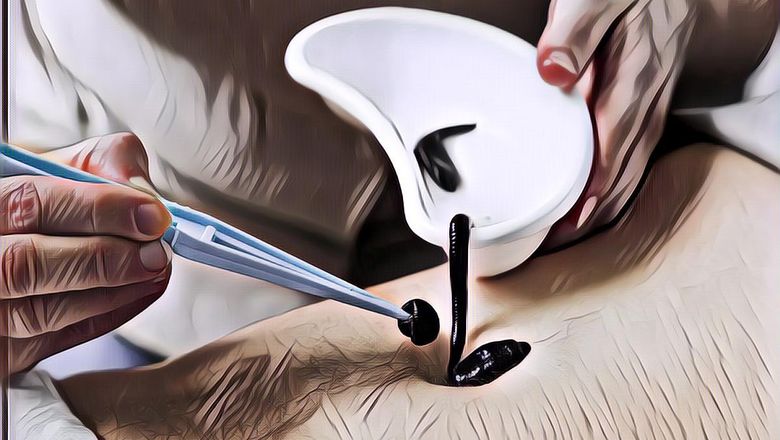 Meski Bikin Geli Ternyata Terapi Lintah Banyak Manfaatnya untuk Kesehatan! Apa Saja?