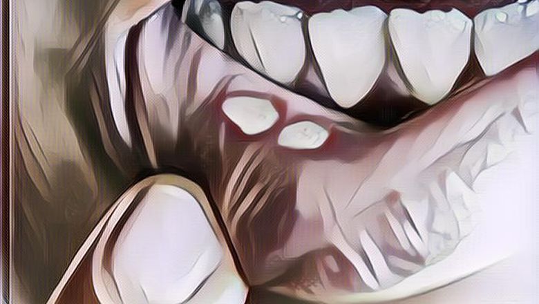 Cara Menghilangkan Sariawan yang Ampuh, Kudu Cobain