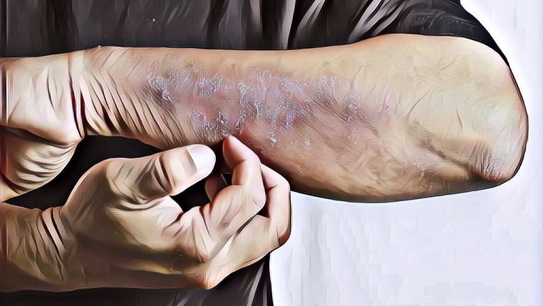 Cara Mengatasi Eksim dengan Bahan-Bahan Alami, Murah dan Aman!