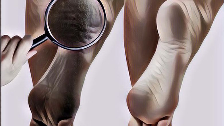 4 Cara Mengatasi Tumit Kaki Pecah-Pecah, Sebelum Bertambah Parah