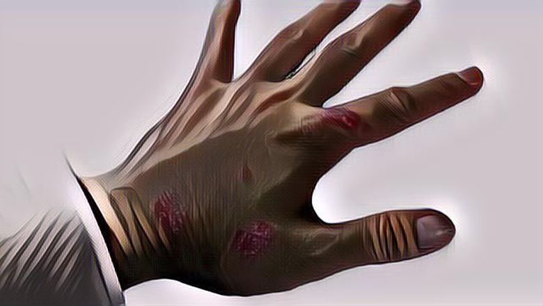 Hati-Hati, Penyakit Kulit Ini Bakal Menghantuimu Selama Musim Hujan