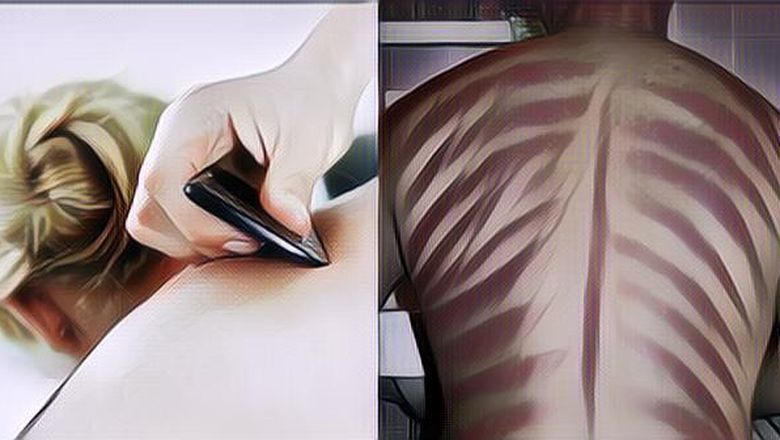 Benarkah Kerokan Bisa Menyembuhkan Masuk Angin? dr. Tirta Ungkap Penelitian Ilmiah Tak Terduga Dari China