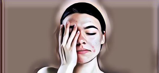 Cara Mengatasi Jerawat pada Remaja, Bye Bye Breakout!