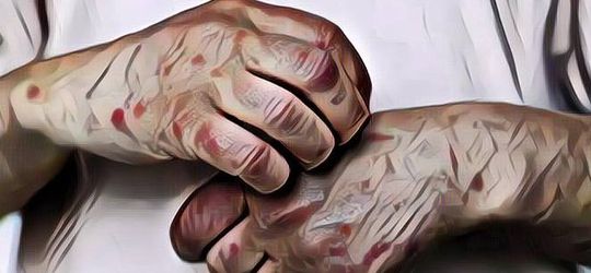 Waspada! WHO Tetapkan Cacar Monyet Sebagai Penyakit Darurat Global