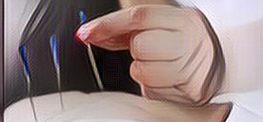 Ini Loh Pengobatan Akupuntur yang Tak Lekang Oleh Waktu