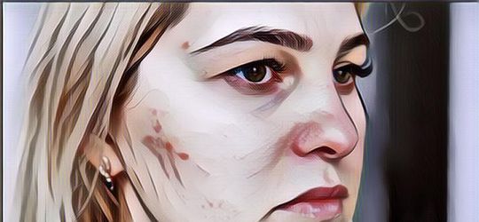 Jarang Pakai Make Up Tapi Wajah Tetap Jerawatan? Mungkin Kebiasaan Ini Jadi Penyebab