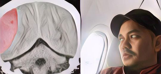 Indra Bekti Akui Kerap Emosional Sejak Alami Pendarahan Otak, Berikut Dampak Stroke pada Psikologi Seseorang