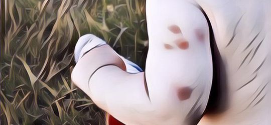 Cara Menghilangkan Bekas Gigitan Nyamuk pada Bayi: Nggak Perlu Panik Lagi Moms