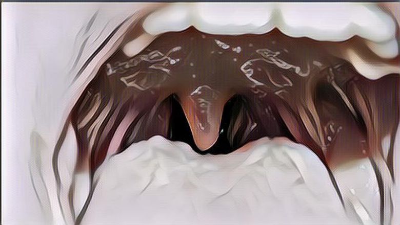 Pengalaman Seorang Ibu yang Pernah Menjalani Operasi Amandel, Siapa Tahu Bermanfaat Buat Kalian yang Sedang Sakit Amandel