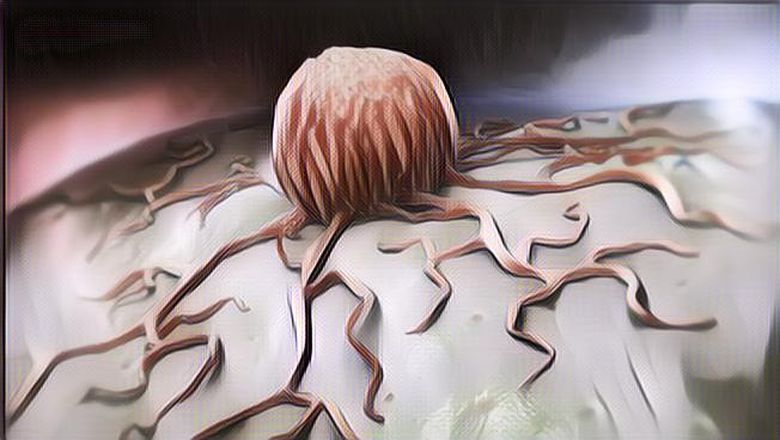 Waspadai Tanda Awal Kanker yang Sedang Berkembang Agar Tidak Terlambat