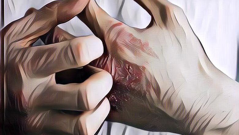 7 Cara Alami Atasi Eksim yang Meradang