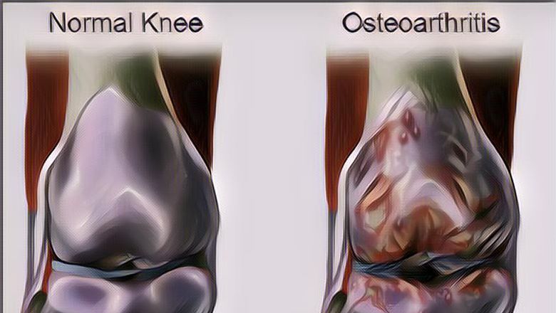 Mengenal Apa Itu Osteoarthritis dan Gejalanya yang Paling Umum