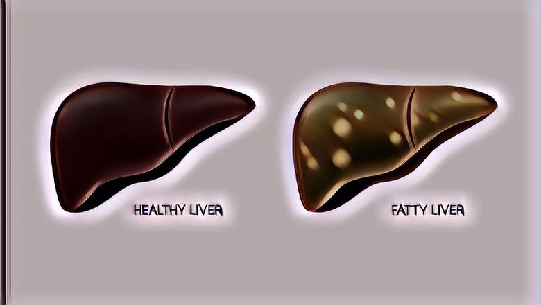 Mengenal Apa Itu 'Fatty Liver' yang Diderita Menteri Kesehatan RI Budi Gunadi