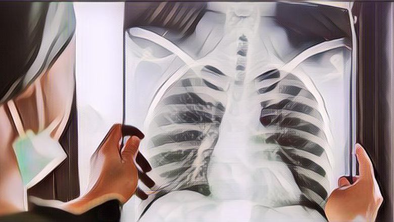 Mengenal Apa Itu Penyakit Bronkitis yang Diderita Anak Zaskia Mecca dan Hanung Bramantyo