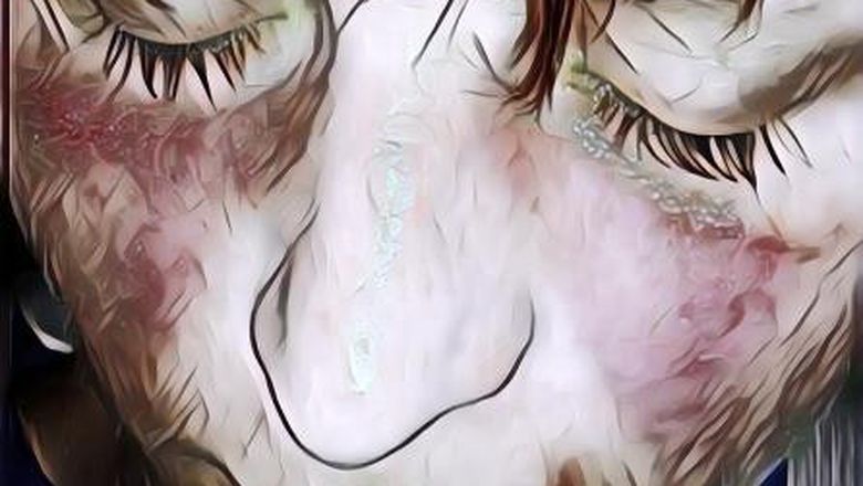 12 Gejala Lupus yang Bisa Kamu Alami Dari Kepala Sampai Ujung Kaki, Kenali Tandanya