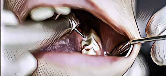 Biar Nggak Makin Parah, Kenali Tanda-Tanda Awal Gigi Berlubang