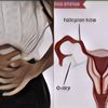 Gejala, Penyebab, Cara Mengobati Hiperplasia Endometrium atau Penebalan Dinding Rahim