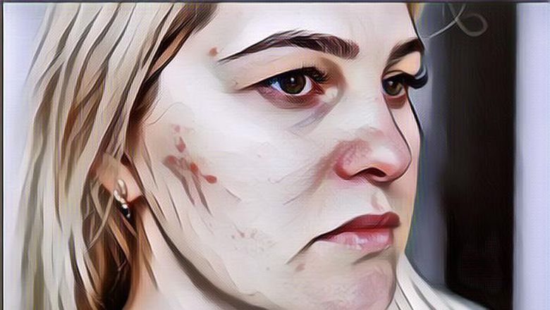 Jarang Pakai Make Up Tapi Wajah Tetap Jerawatan? Mungkin Kebiasaan Ini Jadi Penyebab