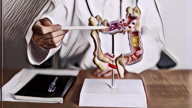 Hati-Hati, Ternyata Kebiasaan Ini Bisa Picu Kanker Usus Lho!