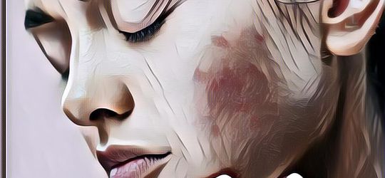 Produk Andalan Wardah untuk Menghilangkan Bekas Jerawat