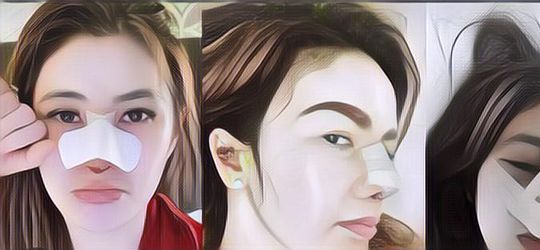 Gak Banyak Orang Tahu, Berikut 10 Efek Samping Operasi Plastik yang Serem Banget