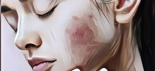 Sering Begadang Bisa Bikin Wajah Jerawatan? Begini Kata Para Ahli