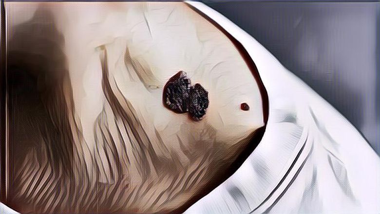 Mengenal Melanoma, Jenis Kanker Kulit Paling Berbahaya yang Bisa Memicu Kematian