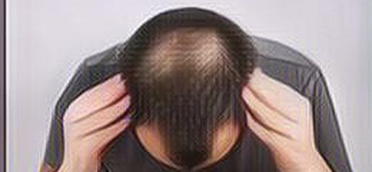 Jangan Menyerah Dulu, Berikut 8 Cara Menumbuhkan Rambut dengan Natural