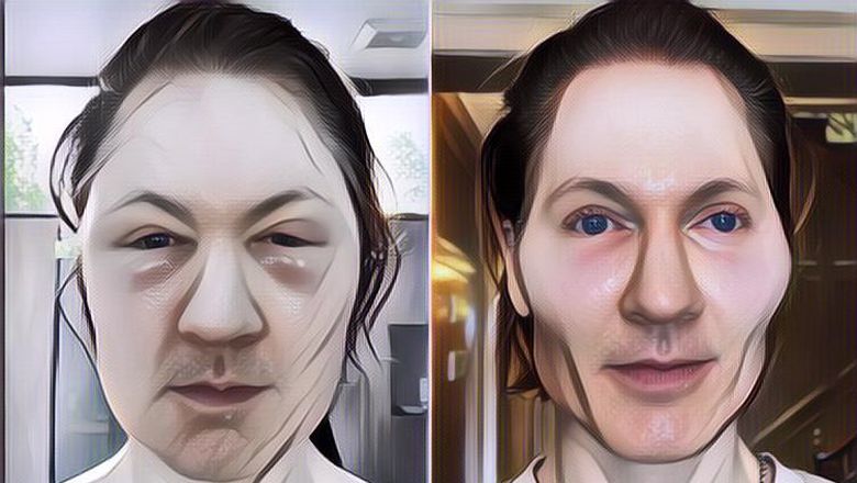 Wajah Miliarder Ini Malah Jadi Aneh Usai Lakukan Suntik Lemak di Wajah Demi Hidup Abadi