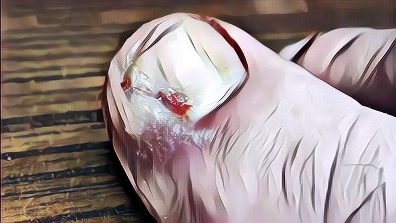 Cara Mengobati Jempol Kaki Cantengan, Kapan Harus ke Dokter?