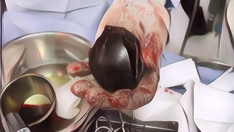 Ngeri! Bola Plastik Tersangkut Di Bokong Pria Ini, Tim Medis Lakukan Operasi 7 Jam Sampai Harus Pakai Bor Listrik