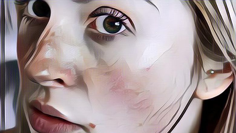 3 Tips Ngilangin Bercak Merah pada Kulit Wajah tanpa Harus ke Dokter Kulit