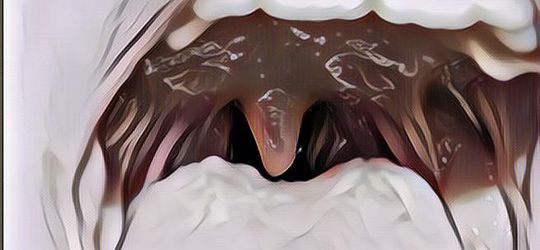 Pengalaman Seorang Ibu yang Pernah Menjalani Operasi Amandel, Siapa Tahu Bermanfaat Buat Kalian yang Sedang Sakit Amandel