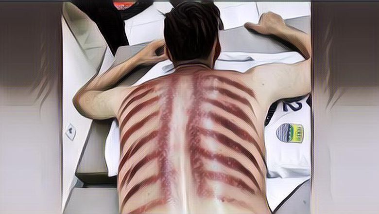 Disebut Ampuh Hilangkan Masuk Angin, Ini Fakta-fakta Tentang Kerokan