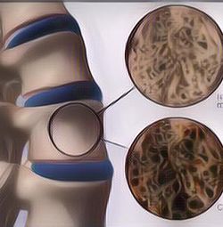 Wajib Tahu! 7 Kebiasaan Buruk Ini Bisa Merusak Tulang