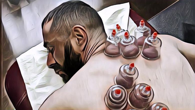 8 Manfaat Terapi Bekam yang Mungkin Belum Kamu Tahu