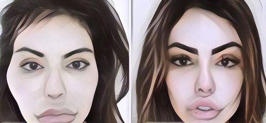 Seram! Model Ini Punya Wajah Hancur Setelah Lakukan Filler