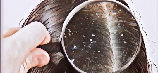 Dijamin Ampuh! Ini 4 Cara Mengobati Ketombe Kering yang Mengganggu