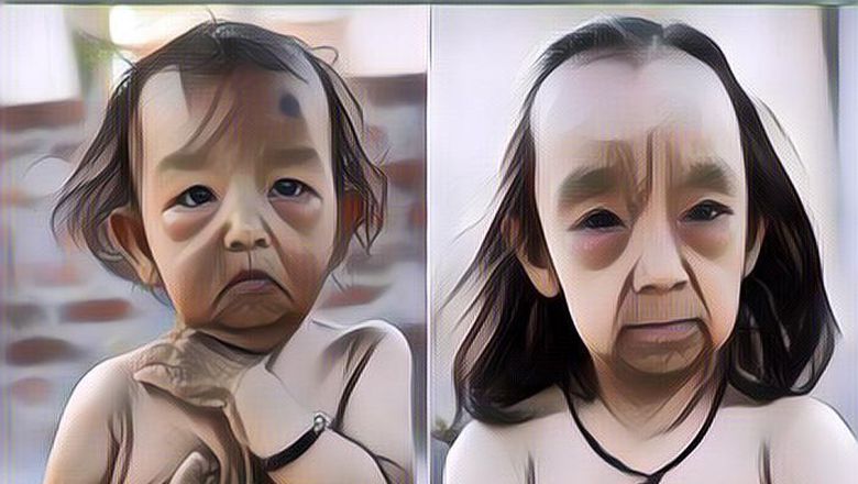 Seperti film "The Curious Case Of Benjamin Button", Bocah Kakak Beradik Ini Derita Penyakit Langka yang Bikin Mukanya Terlihat Tua Banget