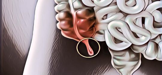 Gejala dan Cara Mencegah Penyakit Usus Buntu, Perhatikan Pola Makan!